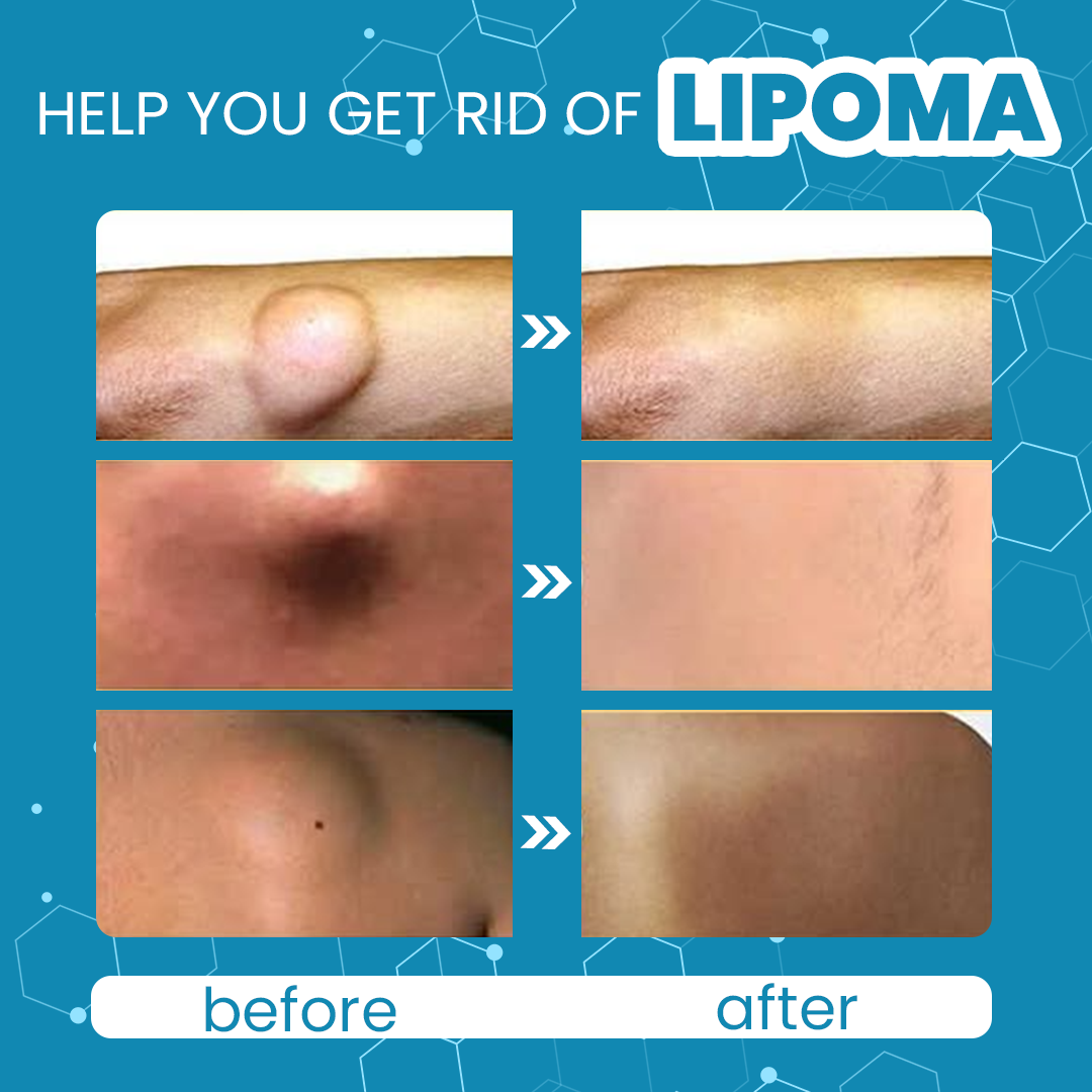 Cvreoz® Κρέμα Αφαίρεσης Λιπώματος