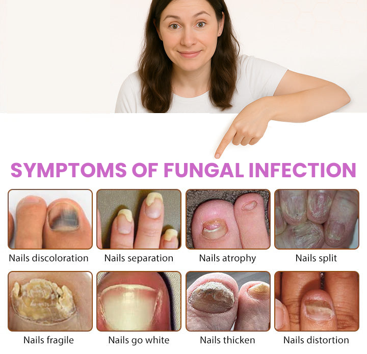 Σπρέι Κατά της Μυκητίασης Νυχιών