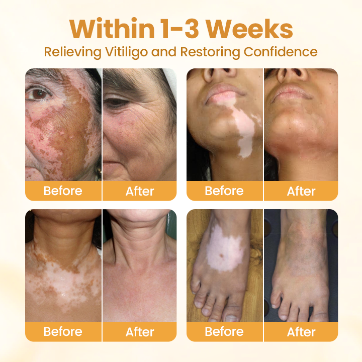 Κρέμα με Δηλητήριο Μέλισσας για Επούλωση & Αποκατάσταση Δέρματος με λεύκη