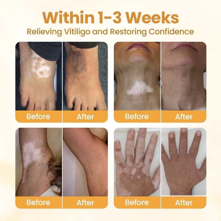 Κρέμα Φωτεινότητας & Ανάπλασης για Λεύκη