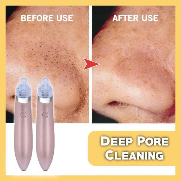 MenoBeauty Pore Cleaner Pro Για ανάταση επιδερμίδας σε ορμονική διαταραχή & εμμηνόπαυση