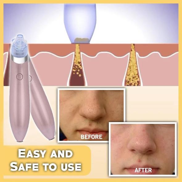 MenoBeauty Pore Cleaner Pro Για ανάταση επιδερμίδας σε ορμονική διαταραχή & εμμηνόπαυση