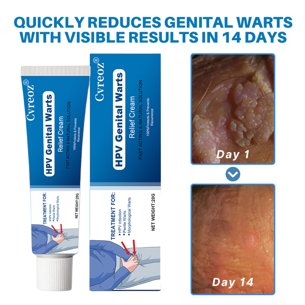 Κρέμα για Κονδυλώματα Γεννητικών Οργάνων