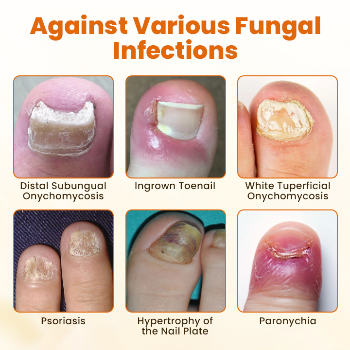 Προηγμένο Σπρέι Επανόρθωσης Νυχιών