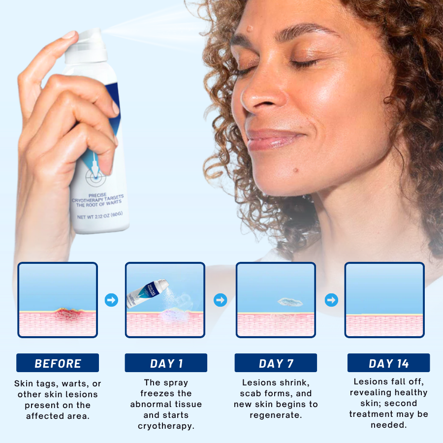 Σπρέι Αφαίρεσης Δερματικών Θηλωμάτων