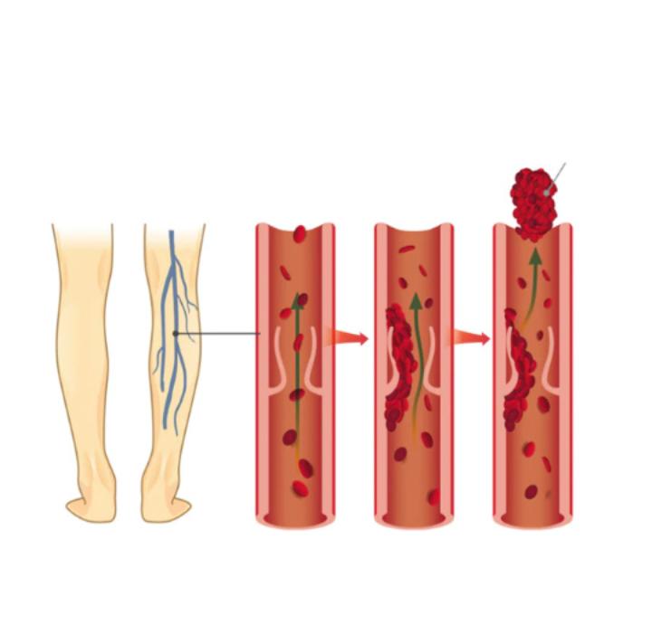 Θεραπευτικές Κρέμες Για Κιρσούς & Ευρυαγγείες