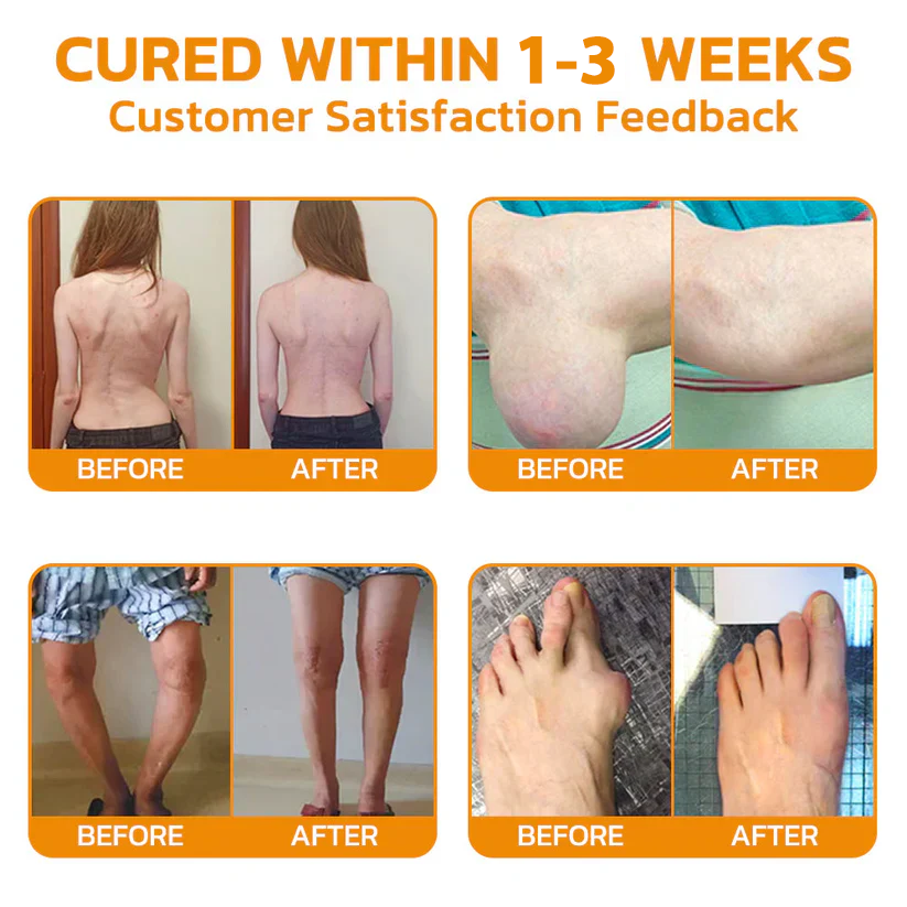 Κρέμα Ανακούφισης Πόνου & Επούλωσης Οστών με Δηλητήριο Μέλισσας