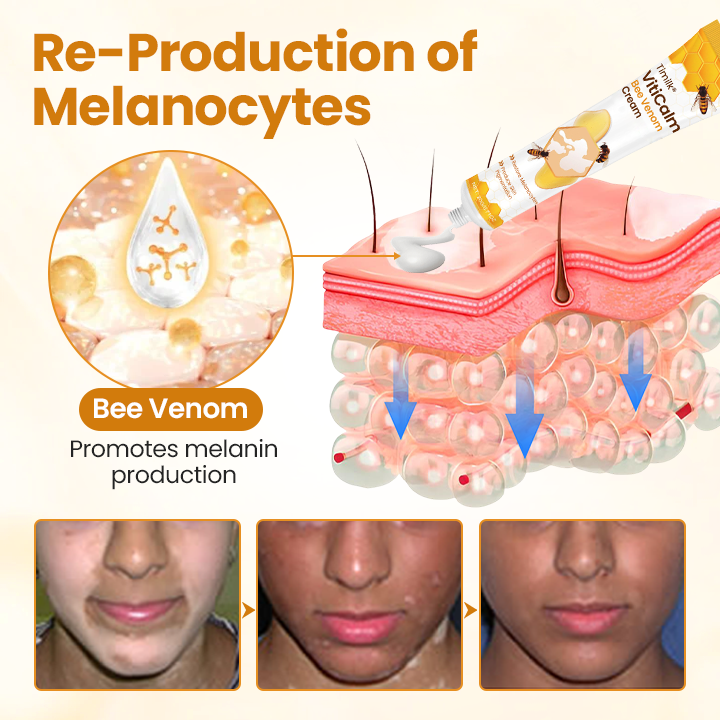 Κρέμα με Δηλητήριο Μέλισσας για Επούλωση & Αποκατάσταση Δέρματος με λεύκη