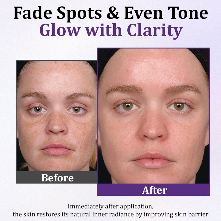 Κρέμα Κατά της Υπερμελάγχρωσης