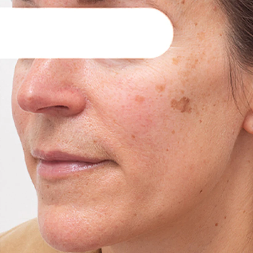 Φυτική Μάσκα Προσώπου για Κηλίδες