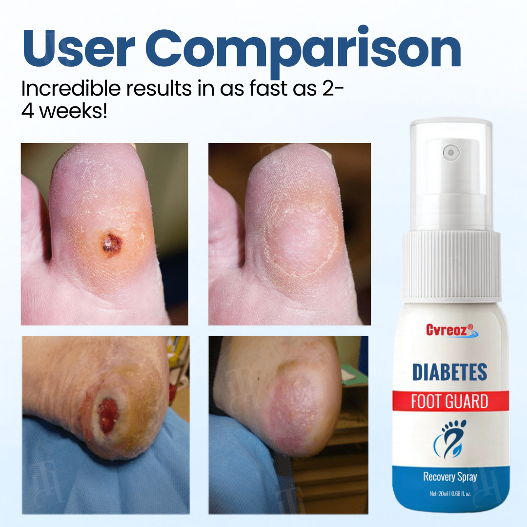 Σπρέι Ανάπλασης Διαβητικού Ποδιού