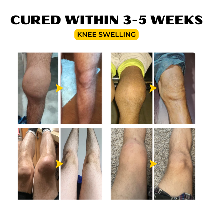 Κρέμα Ανακούφισης με Δηλητήριο Μέλισσας