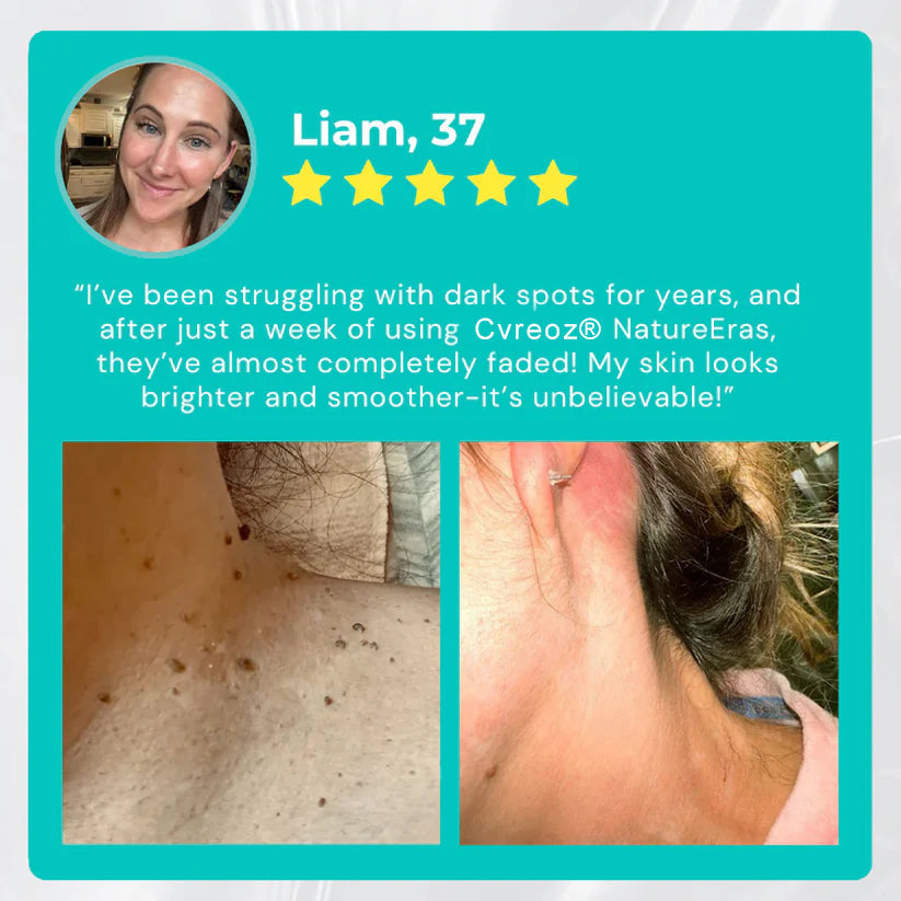 Άμεση Κρέμα για Ελιές & Κηλίδες NatureErase