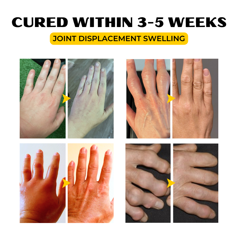 Κρέμα Ανακούφισης με Δηλητήριο Μέλισσας