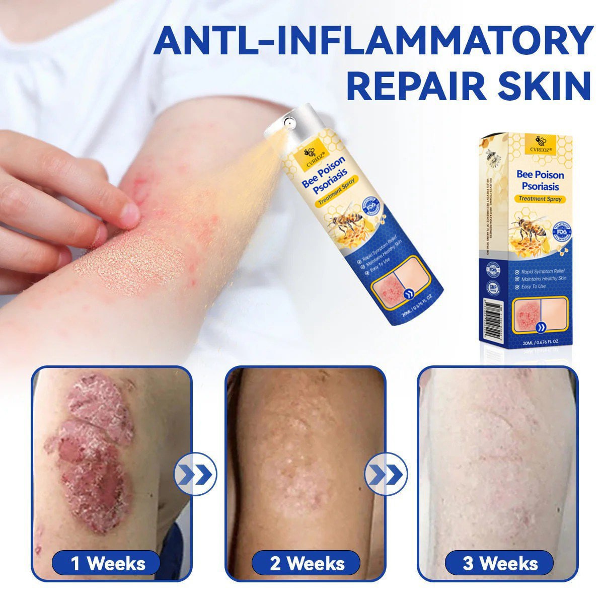Σπρέι Θεραπείας Ψωρίασης με Δηλητήριο Μέλισσας