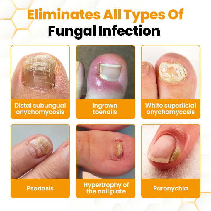 Αντιμυκητιακό Λάδι Αναζωογόνησης Νυχιών με Δηλητήριο Μέλισσας