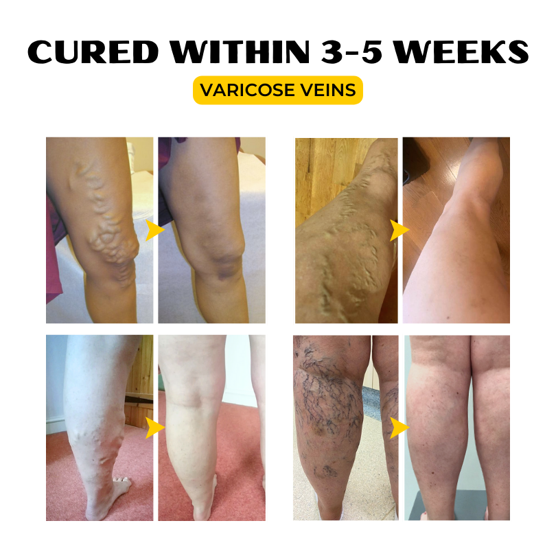 Κρέμα Ανακούφισης με Δηλητήριο Μέλισσας