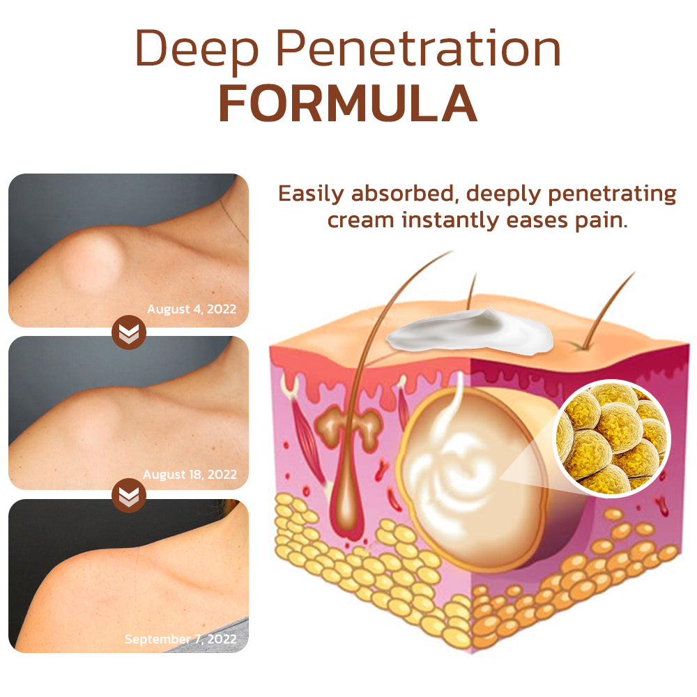 Φυσική Κρέμα κατά των Λιπωμάτων