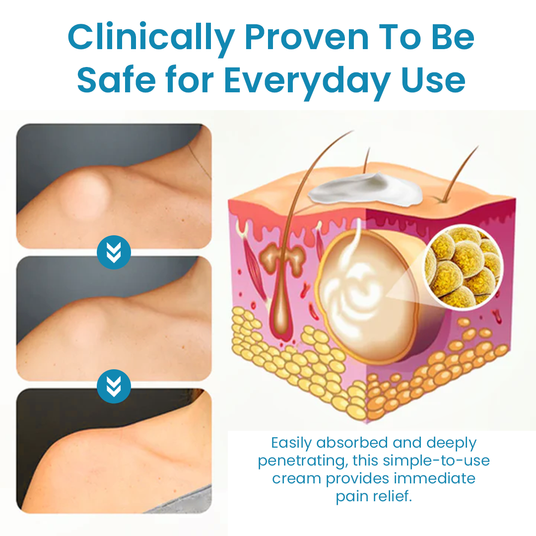 Cvreoz® Κρέμα Αφαίρεσης Λιπώματος