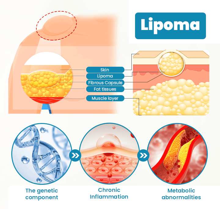 Cvreoz® Κρέμα Αφαίρεσης Λιπώματος