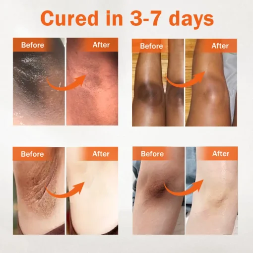 Έλαιο Κατά των Μαύρων Κηλίδων & Ακάνθωσης