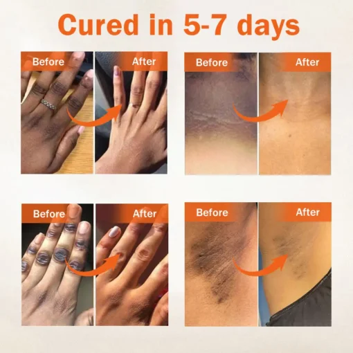 Έλαιο Κατά των Μαύρων Κηλίδων & Ακάνθωσης