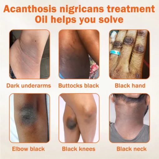 Έλαιο Κατά των Μαύρων Κηλίδων & Ακάνθωσης