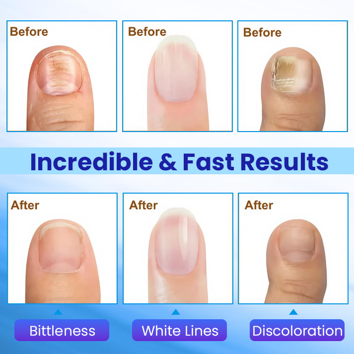 ✨ Επίσημο Κατάστημα | Timilk®  Αντιμυκητιακή Κρέμα Νυχιών 🦶 Ξεφορτώσου Μύκητες, Οσμές & Ασχήμια — Οριστικά.