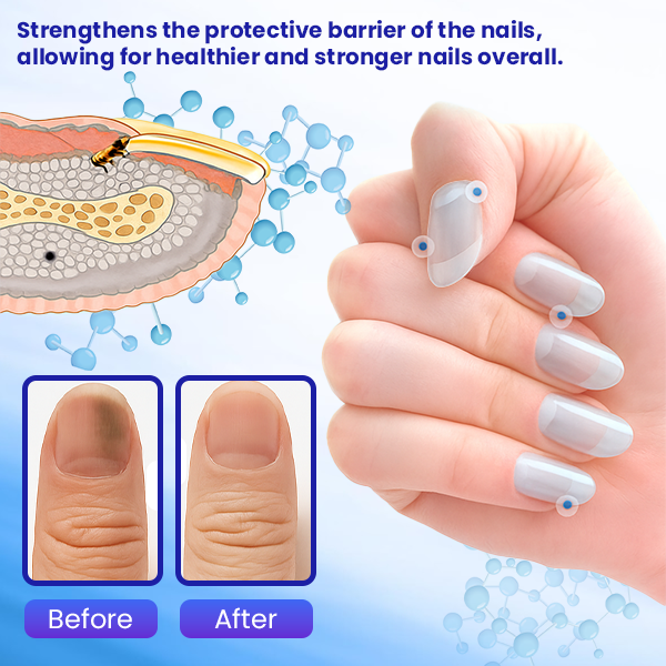 ✨ Επίσημο Κατάστημα | Timilk®  Αντιμυκητιακή Κρέμα Νυχιών 🦶 Ξεφορτώσου Μύκητες, Οσμές & Ασχήμια — Οριστικά.