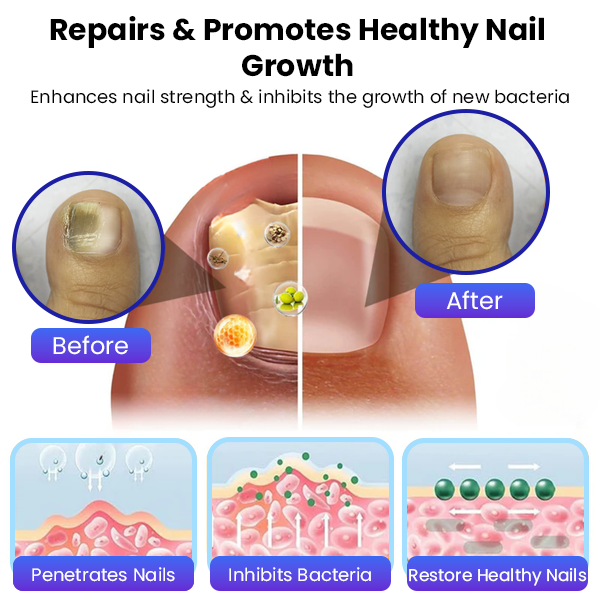 ✨ Επίσημο Κατάστημα | Timilk®  Αντιμυκητιακή Κρέμα Νυχιών 🦶 Ξεφορτώσου Μύκητες, Οσμές & Ασχήμια — Οριστικά.