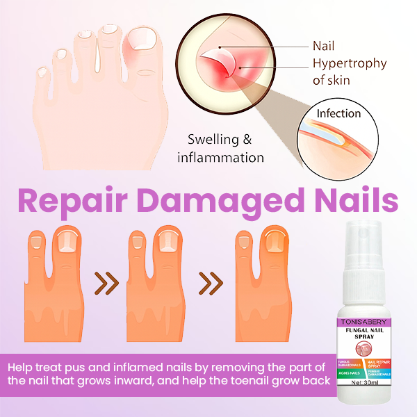 Σπρέι Κατά της Μυκητίασης Νυχιών