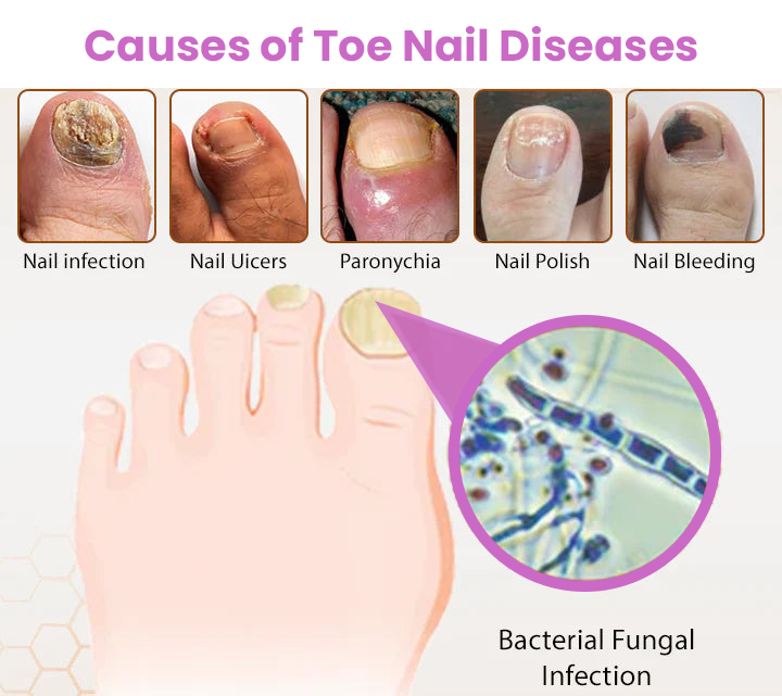 Σπρέι Κατά της Μυκητίασης Νυχιών