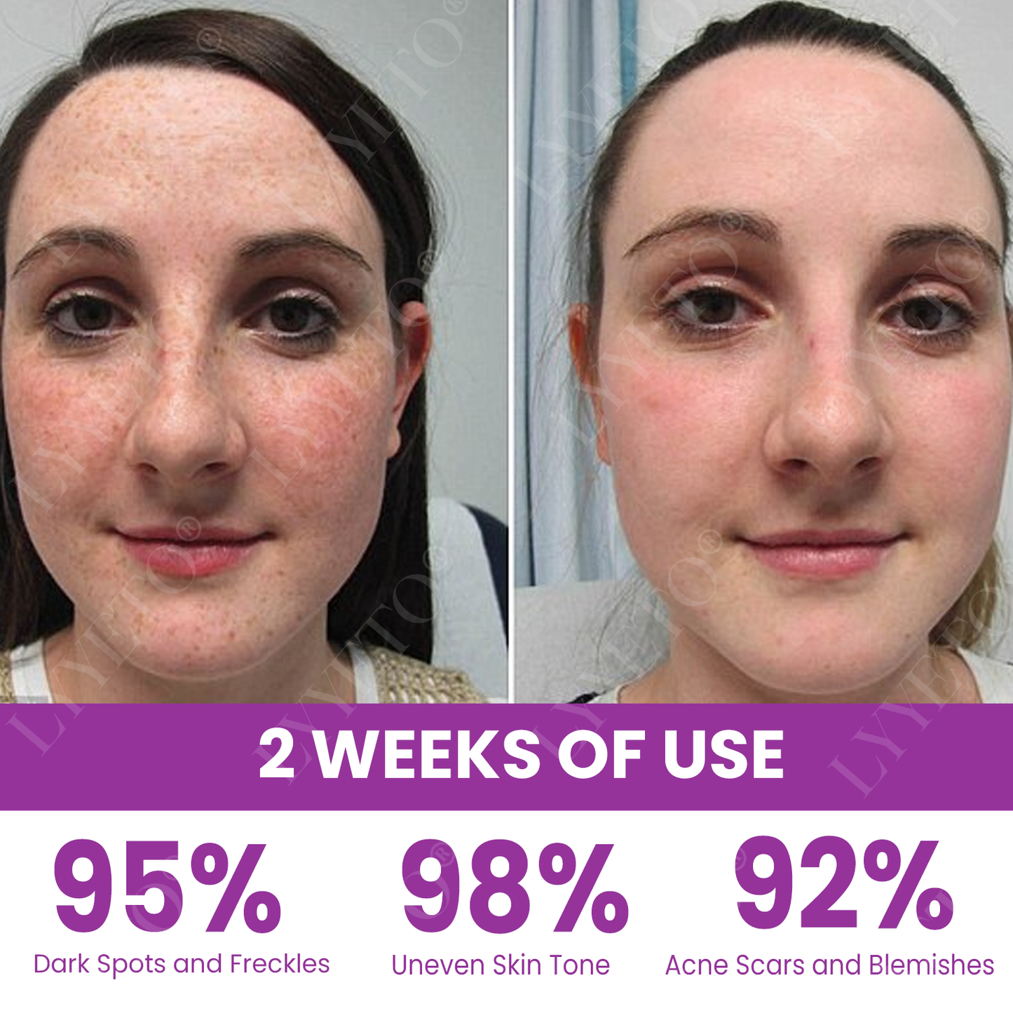 Προηγμένο Λευκαντικό Serum ACE