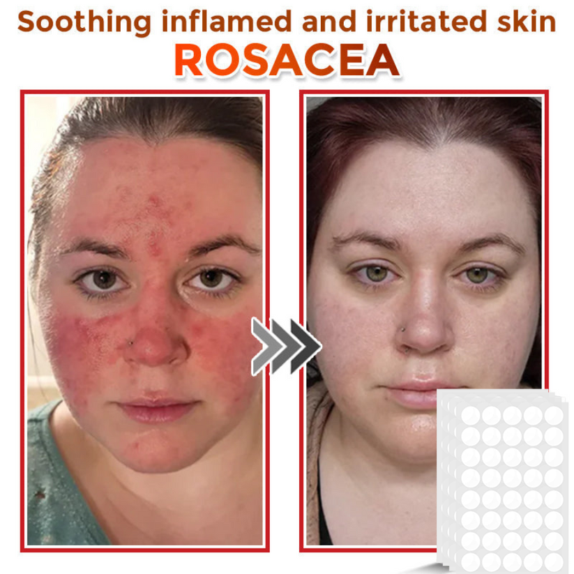 Φυτικά Έμπλαστρα Αφαίρεσης Θηλωμάτων