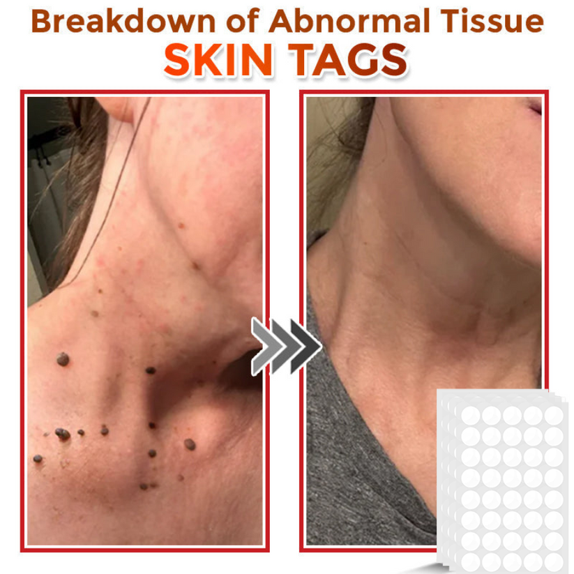 Φυτικά Έμπλαστρα Αφαίρεσης Θηλωμάτων