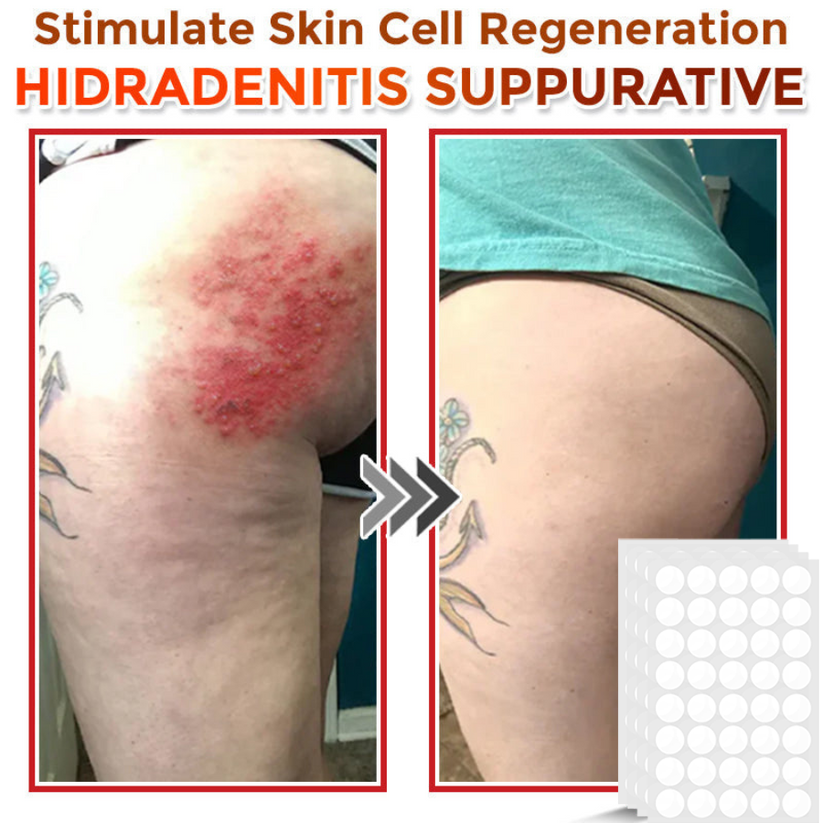 Φυτικά Έμπλαστρα Αφαίρεσης Θηλωμάτων