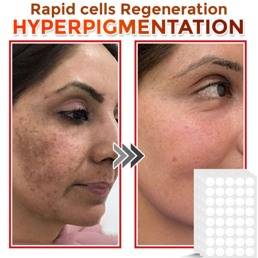 Φυτικά Έμπλαστρα Αφαίρεσης Θηλωμάτων