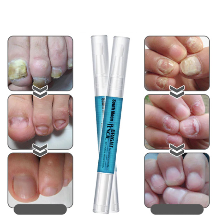 Στυλό Για Θεραπεία Μυκήτων & Αποκατάσταση Της Υγείας Των Νυχιών