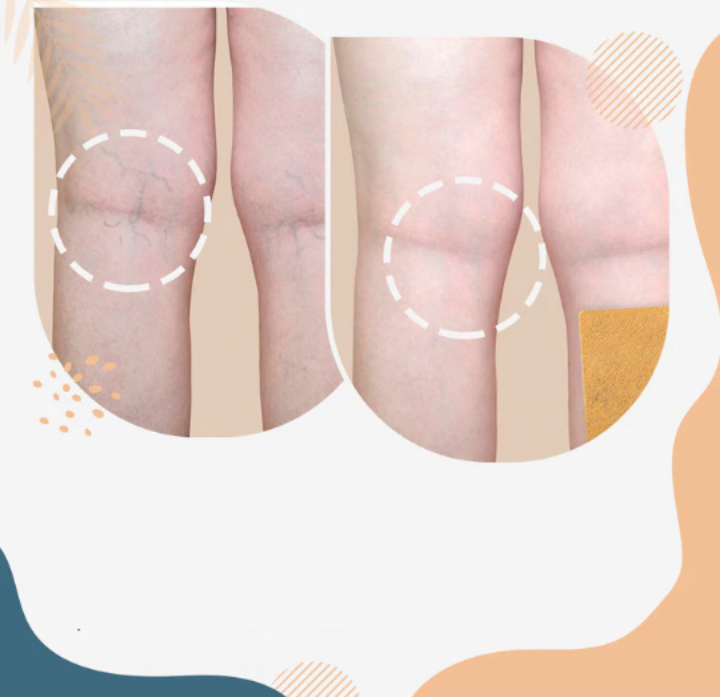 Επιθέματα Για Την Αντιμετώπιση Των Κιρσών!