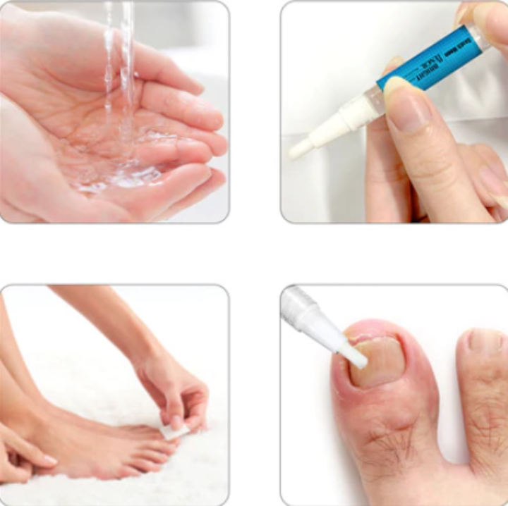 Στυλό Για Θεραπεία Μυκήτων & Αποκατάσταση Της Υγείας Των Νυχιών
