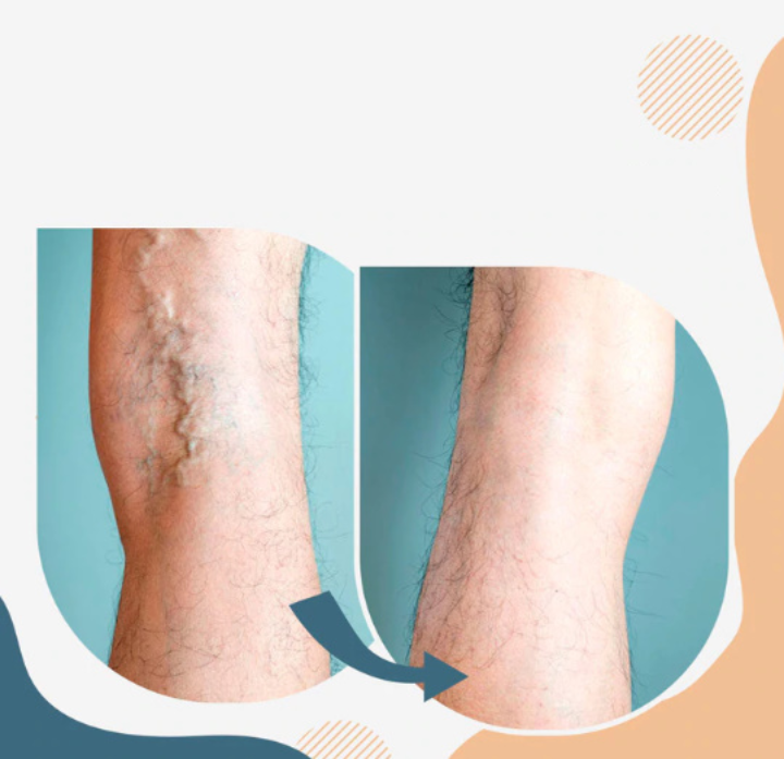 Επιθέματα Για Την Αντιμετώπιση Των Κιρσών!