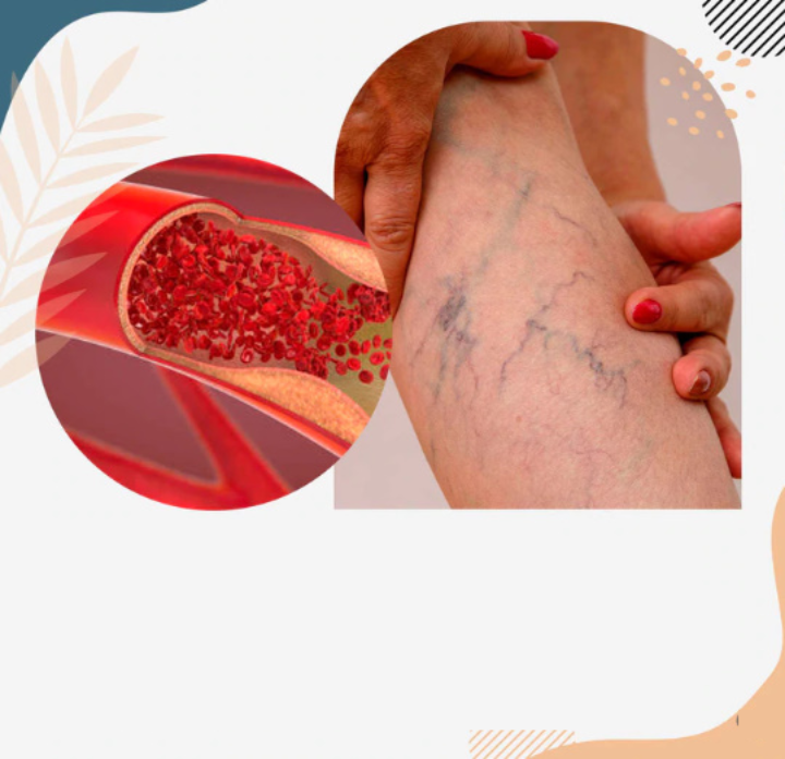 Επιθέματα Για Την Αντιμετώπιση Των Κιρσών!